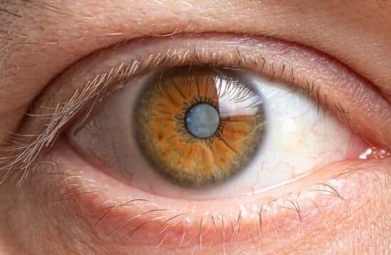 Understanding Cataract Surgery: Your Complete Guide to Clearer Vision