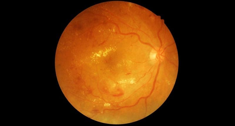 Diabetic Retinopathy: Symptoms, Causes, Stages & Best Treatment Options
