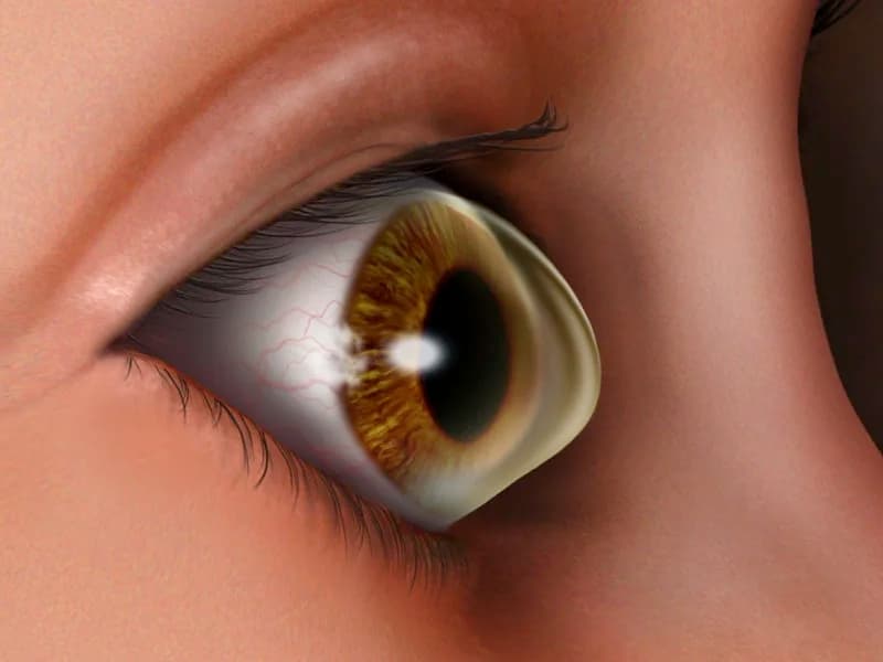 keratoconus treatment in delhi ncr