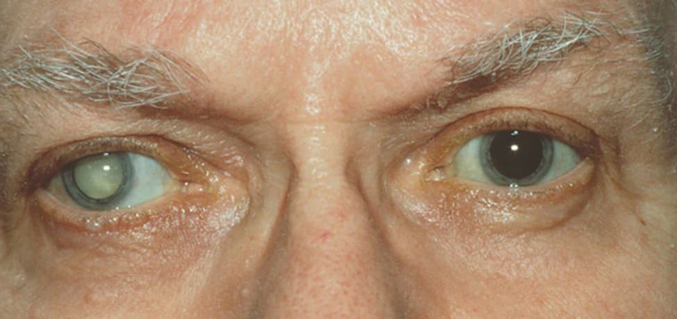 Best Cataract Surgery in Greater Kailash Delhi NCR | Netram Eye Foundation